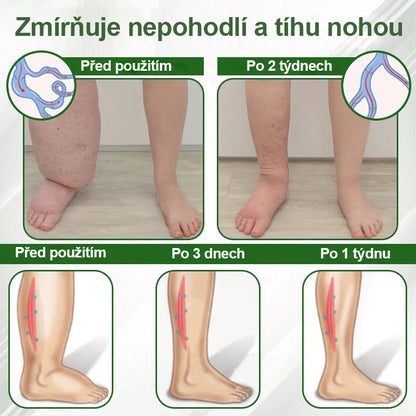 🌿🌿Malenia® Bylinný krém zmírňující otoky s černuchou