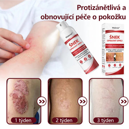 🔥Malenia® Snail Repair Spray pro svědivou, šupinatou pokožku s psoriázou